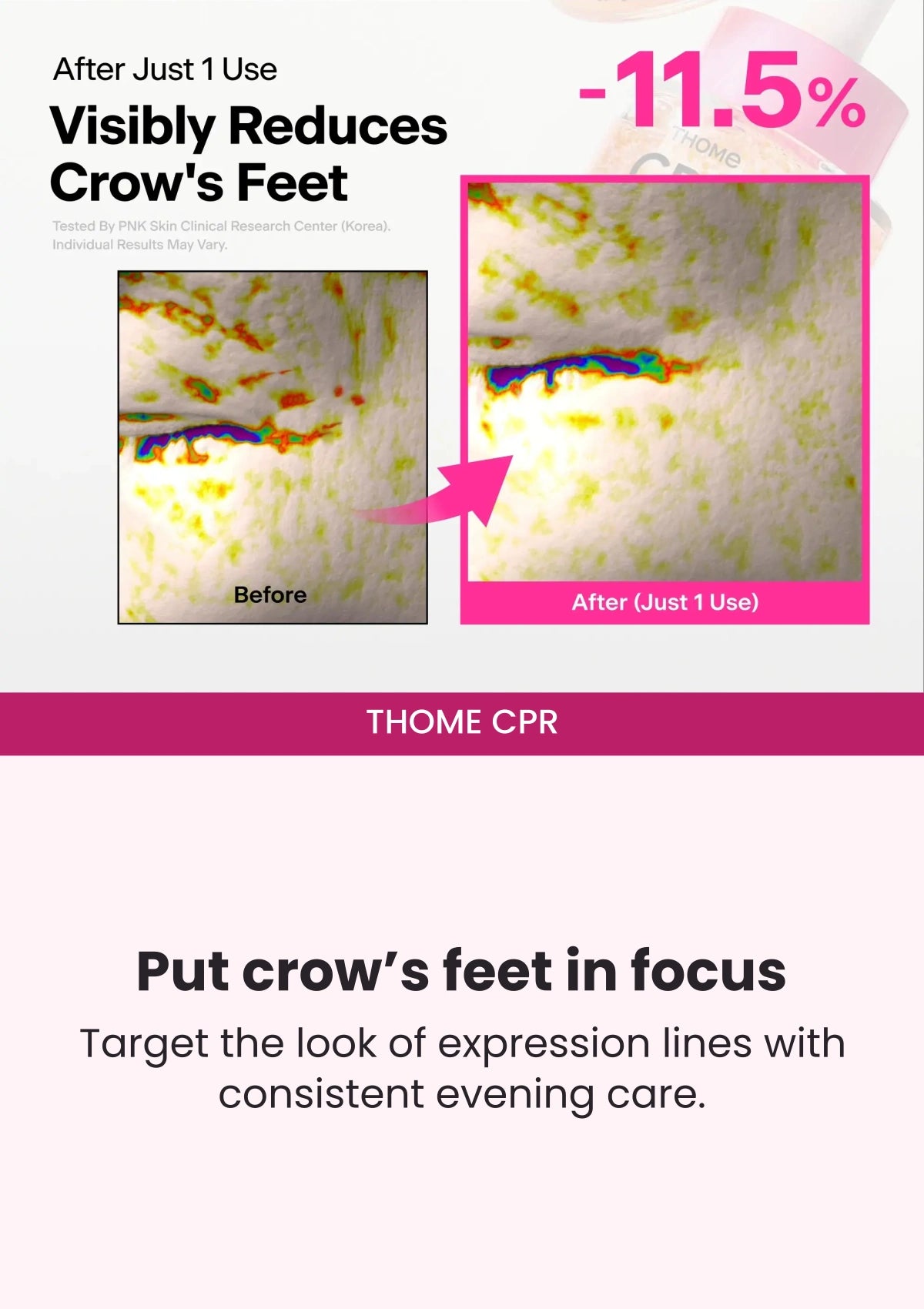 THOME CPR — Crow’s feet after one use