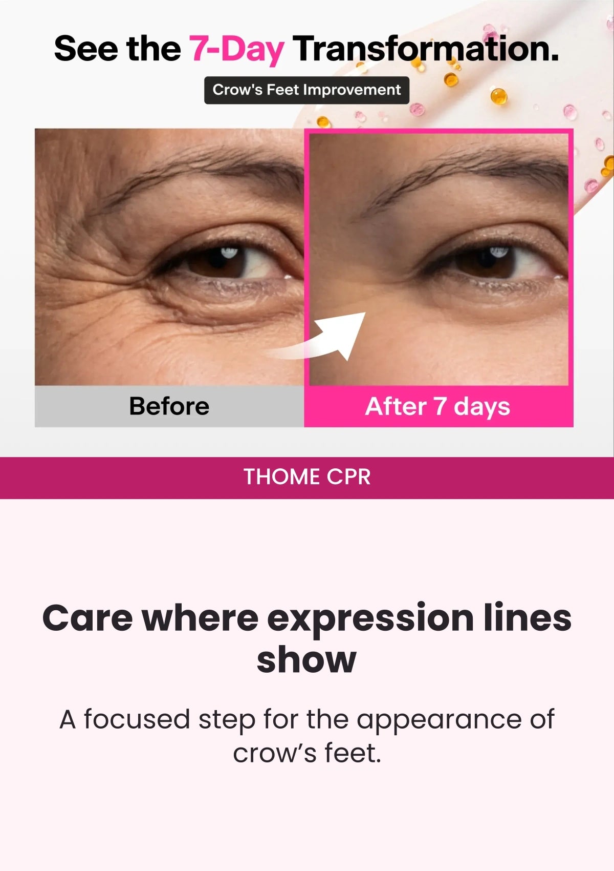 THOME CPR — Seven-day crow’s-feet transformation